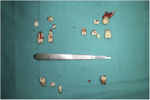 Extracted teeth and aligned with intraoral positions.