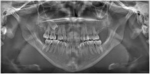 Panoramic radiograph after a 4-year follow-up (retained maxillary right premolar tooth of the patient can be seen).