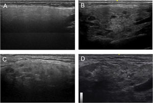 Parotid longitudinal scan assessment. Grade 0 (A), grade I (B), grade II (C), grade III (D).