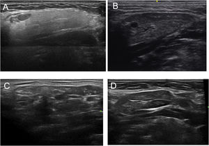 Submandibular longitudinal scan assessment. Grade 0 (A), grade I (B), grade II (C), grade III (D).
