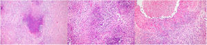 Examen microscópico de pieza de orquiectomía simple con tinción de hematoxilina-eosina. A. Necrosis geográfica. B. Granuloma necrotizante. C. Vasculitis.