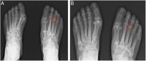 Non-weighbearing (A) and weightbearing (B) anteroposterior radiographs of the patient's foot, representing avascular necrosis of right third metatarsal head (red circles).