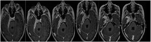Secuencia T1 de la RMN con contraste donde se evidencia engrosamiento paquimeníngeo temporal que rodea las estructuras vasculonerviosas y el edema cerebral.