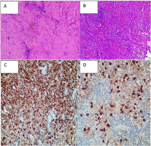 A y B) Corresponden a la visualización microscópica que evidencia infiltrado linfoplasmocitario y fibrosis arremolinada. C) Muestra la tinción de las células IgG. D) Tinción para IgG4+.
