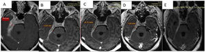 Secuencias en T1 de la RMN sucesivas en la evolución de la paciente. Desde (A) lesión basal con engrosamiento de aproximadamente 2cm, hasta (D) estado posterior al tratamiento con esteroides y rituximab que evidencia la mejoría franca del engrosamiento y el edema. E) Cortes tardíos que muestran zonas de fibrosis.