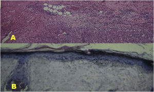 (A) Histological section of the lateral foot (scar area) revealing small vessel vasculitis associated with areas of scarring fibrosis and dystrophic calcification. There are no alcohol-acid-resistant bacilli. Compatible with erythema nodosum leprosum with scar areas. (B) Histological section of the scalp region revealing mild hyperkeratosis, epidermal atrophy, ballooning of basal keratinocytes and discrete perivascular lymphohistiocytic infiltrate. Compatible with lupus erythematosus.