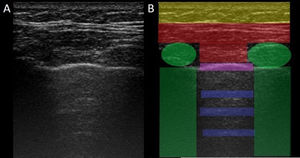 Imagen de ultrasonido normal realizado en paciente sano, obtenida con equipo GE Logiq 3 con transductor lineal multifrecuencia de 10-14MHz, en el tercer espacio intercostal derecho, con paciente en posición decúbito supino y transductor en orientación longitudinal. A) Imagen original. B) Resaltado en amarillo piel y tejido celular subcutáneo; en rojo, capas miofasciales; en verde, costillas y la sombra acústica qgenran; en morado, línea pleural, y en azul, líneas A.