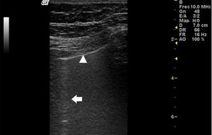 Ultrasonido pulmonar realizado a la misma paciente de la figura 2 con equipo GE Logiq 3, con transductor lineal multifrecuencia de 10-14MHz, con la paciente en posición sentada y transductor en orientación longitudinal. La flecha señala una línea B. El triángulo señala la línea pleural, que se observa de aspecto irregular. Nótese la ausencia de líneas A.