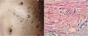 Multiple firm hyperpigmented nodules on the chest (a) of a 27-year-old woman (b) Proliferation of myofibroblasts and haphazardly arranged thick hyalinized collagen bundles (H&E ×100).