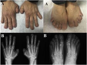 A. Deformidad en telescopaje y aspecto característico de dedos cortos y anchos en las manos y los pies. B. Osteólisis en banda de las falanges distales, con pseudofracturas al nivel de la 4.ª y 5.ª MTF del pie izquierdo y de la 5.ª MTF del pie derecho.