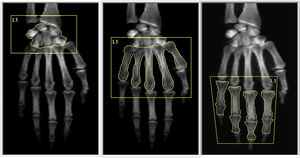 Hand images derived from DXA showing three analyzed ROI using a modified technique in Hologic device: (A) carpus. (B) metacarpal bones and (C) phalanges.