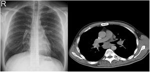 Comparison of CXR (normal) versus CT imaging (bilateral hilar and mediastinal lymphadenopathies).