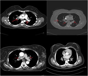 Some illustrative CT imaging of patients with sarcoidosis.