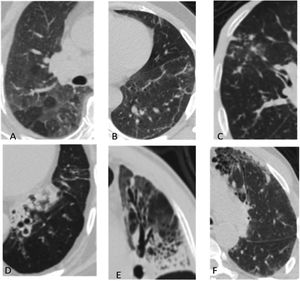 Typical MSCT findings of interstitial lung abnormalities. (A) Ground glass abnormalities, (B) reticular abnormalities with ground glass opacities, (C) tree in bud appearance, (D and E) traction bronchiectasis with reticulation and ground glass attenuation, and (F) honey combing demonstrated as clustered cystic air spaces.
