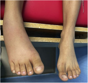 Imagen comparativa del tercio distal de ambas extremidades inferiores donde observamos tobillo y pie derechos con aumento de volumen mal definido.