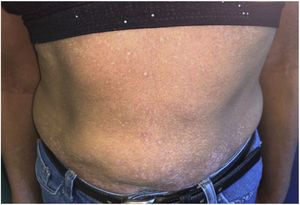 A la exploración física se observaba leucomelanodermia con morfología de hipomelanosis reticulada.