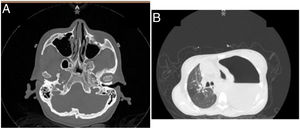 A) Tomografía computarizada muestra sinusitis etmoidal, maxilar bilateral y esfenoidal derecha aguda, desviación septal hacia la izquierda, hipoplasia de senos frontales. B) Derrame pleural izquierdo severo, neumotórax a tensión, sin evidencia de lesiones nodulares.