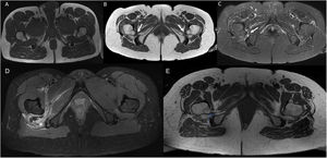 Composición de imágenes RM en el plano axial. Secuencias potenciadas en T1 (A y B) y STIR (C). A)Imagen de anatomía normal. B)Paciente número 2 de nuestra serie: disminución bilateral del espacio isquiofemoral (flechas blancas). C)El mismo paciente, donde además se aprecia leve edema en las partes blandas (cuadrado femoral) del espacio isquiofemoral derecho y atrofia de ambos. D)Imagen de RM en plano axial. Secuencia potenciada en densidad protónica (DP) con saturación grasa. Engrosamiento con edema y hematoma en músculo cuadrado femoral derecho (*) por rotura en paciente con pinzamiento del espacio isquiofemoral. E)Imagen RM en plano axial. Secuencia potenciada en T1. Medición del espacio cuadrado femoral e isquiofemoral en paciente con pinzamiento.