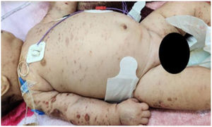 Infant (Case 1) with Chikungunya and cytokine storm.