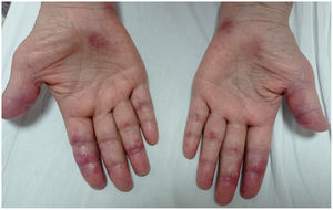 Máculas eritematovioláceas en palmas y región palmar de dedos con signos incipientes de ulceración en el cuarto dedo de la mano izquierda, hallazgos cutáneos típicos de dermatomiositis anti-MDA5.