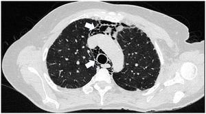 TAC de tórax de alta resolución que demuestra neumomediastino aislado, sin evidenciar neumotórax ni enfisema subcutáneo.