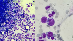 Biopsia de médula ósea de nuestro paciente número 2. Muestra histológica teñida con tinción de Giemsa. Visión al microscopio óptico a 50 aumentos (×50, izquierda) y a 100 aumentos (×100, derecha). En ella podemos observar la serie mieloide correctamente representada, sin detención madurativa ni aumento de células blásticas. Especialmente destaca la vacuolización citoplasmática en células mieloides, característica del síndrome VEXAS. En la muestra obtenida también observamos mínimos cambios displásicos en la serie eritroide, así como la presencia de marcada eosinofilia.
