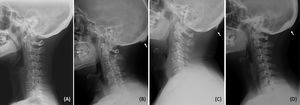 Tipos de morfología de entesofito occipital (flechas blancas): (A) normal, (B) artritis psoriásica, (C) espondiloartritis, (D) artritis reumatoide.