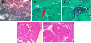 Biopsia muscular del caso clínico. Tinción tricrómico modificado de Gomori (TMG). Acercamiento 200× TMG, la tinción mostró fibras musculares de tamaño variable, abombamiento, agregados de células inflamatorias con invasión focal de algunas fibras musculares y una gran proliferación de tejido conectivo (A). Acercamiento a 400× TMG, con una evidente centralización nuclear (flecha) (B). Acercamiento 400× TMG Se observa vacuolas bordeadas con material granular y filamentos (estrella) clásicos de la patología (C). Tinción hematoxilina y eosina (H&E). Acercamiento 100×, vista panorámica de la biopsia donde se observa gran cambio en la arquitectura general, con aumento de los espacios y sustitución por tejido conectivo, morfología de las fibras con abombamiento e infiltrado inflamatorio (D), Acercamiento a 400× (H&E) muestra con más detalle el infiltrado inflamatorio que bordea a la fibra muscular (E) además de tejido conectivo abundante.