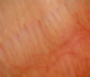 Nailfold capillaroscopy image showing normal hair pin capillaries with prominent sub papillary venous plexus in healthy control person.