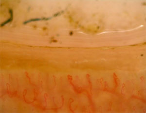 Nailfold capillaroscopy image showing tortious capillaries with prominent sub papillary venous plexus in case of membranous nephropathy.
