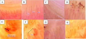 Nailfold capillaroscopic examination findings: (A) tortuosity, (B) elongation, (C) crossing, (D) microhemorrhages, (E) giant capillaries, (F) avascular areas, (G) neoangiogenesis, and (H) venus plexus visibility.
