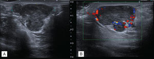 Ecografía de la lesión hipoecogénica, multilobulada, bien definida y heterogénea (A) y con flujo Doppler (B).