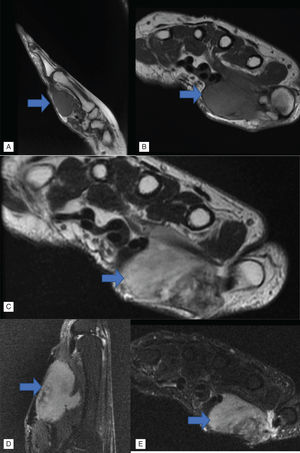 Resonancia. Presencia de lesión hipointensa en cortes sagital y axial T1 (A, B), e hiperintensa en corte axial T2 (C) y cortes sagital y axial STIR (D, E).