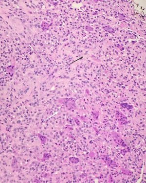 Anatomía patológica de tumor de células gigantes de la vaina tendinosa. La flecha negra señala un macrófago epitelioide y la blanca, un ejemplo de célula gigante multinucleada. HE, 40×.