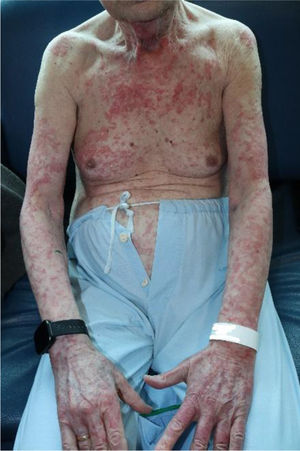 Erupción eritematodescamativa generalizada.