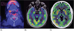 A) Tomografía por emisión de positrones (PET-TC) del caso 1. Se observa alteración en la densidad de las glándulas salivales que se correlaciona con enfermedad de Sjögren, con un foco de metabolismo incrementado en la glándula submandibular derecha de 10mm con SUVmáx de 5,8. B y C) PET-TC del caso 2. Se observan, con aumento del metabolismo en ambos hipocampos, la corteza temporal derecha y ambos putámenes. El resto de la corteza se observa con hipometabolismo generalizado.
