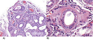 A) Biopsia de glándula salival menor con atrofia de acinos mucinosos con foco de infiltrado linfoide moderado de más de 50 linfocitos que rodean los conductos dilatados, así como datos de fibrosis, ectasia ductal y abundantes cuerpos apoptóticos. Tinción hematoxilina-eosina, ×10. B) Infiltración linfocítica periductal leve de más de 50 linfocitos por campo. Tinción hematoxilina-eosina ×40.