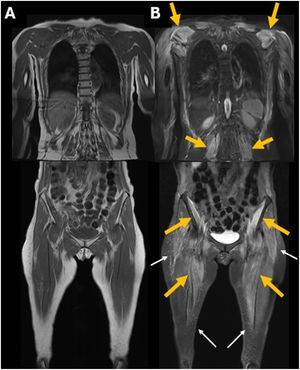 Whole-body MRI in coronal T1-weighted (A) and STIR-weighted (B) images. Relatively symmetrical, bilateral edema of the proximal musculature (orange arrows), primarily in the scapular and pelvic regions, as well as in the paraspinal muscles. No significant atrophy was identified. Minimal subcutaneous stranding was also noted (white arrows).