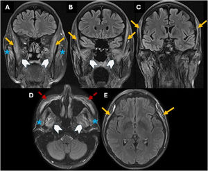 Brain MRI in fluid-attenuated inversion recovery (FLAIR sequence) – coronal (A–C) and axial (D, E) images. Notable bilateral and symmetrical edema of the masticatory muscles, involving the superficial temporalis (orange arrows), masseters (blue asterisks), and pterygoids (white head arrows). Cosmetic filling material was present in the anterolateral facial subcutaneous (red dashed arrows).