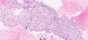 Imagen de bloque celular sobre citología (hematoxilina eosina ×20). Sobre fondo hemático, se observan granulomas compuestos por células histiocitarias, en ausencia de necrosis.