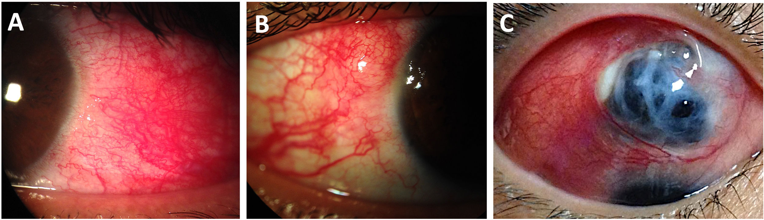 Ocular inflammatory manifestations in patients with rheumatoid ...