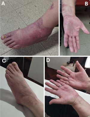 Skin lesions after the first switch to a biosimilar and the subsequently improvement after reintroduction of the first one. (A, B) Lesions post-Amgevita®. (C, D) Improvement of the skin lesions after Hyrimoz® reintroduction.