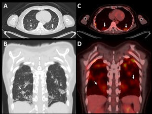 (A) Chest CT (transverse view) shows bilateral lower lobe ground-glass opacities with mild bronchiectasis. (B) Coronal CT view highlights interstitial reticulation. (C) PET scan (transverse view) reveals hypermetabolic uptake in both posterior lung regions (SUVmax 4.8). (D) Coronal PET image confirms symmetric inflammatory activity in the lower lungs.