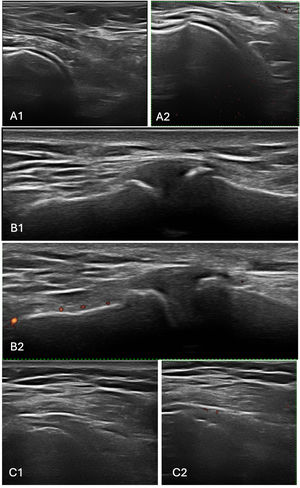 Ultrasound findings in a patient with rheumatoid arthritis without rotator cuff tendinopathy. Images of the left shoulder showing active synovitis and arthrosis of the acromioclavicular and glenohumeral joints. (A1) Longitudinal grayscale view of the anterior glenohumeral joint. (A2) Corresponding Doppler view. (B1) Grayscale image of the left acromioclavicular joint. (B2) Doppler image of the same region. (C1) Posterior glenohumeral joint in grayscale. (C2) Doppler image of posterior glenohumeral joint.