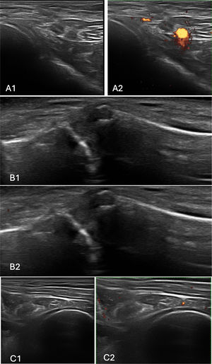 Ultrasound findings in a patient with rheumatoid arthritis and rotator cuff tendinopathy. Images of the right shoulder showing degenerative changes in the acromioclavicular and glenohumeral joints, with no evidence of synovitis. (A1) Grayscale longitudinal view of the anterior glenohumeral joint. (A2) Corresponding Doppler image. (B1) Grayscale images of the acromioclavicular joint. (B2) Doppler signal of the same region. (C1) Posterior glenohumeral joint in grayscale. (C2) Corresponding Doppler image.