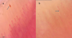 Capillary abnormalities at 200×. (a) Microhemorrhage in a male patient with CD and (b) ramified capillary in a female patient with UC.