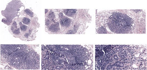 Imagen histología de glándula salival menor labial. Tejido de glándula salival menor representada por 4 acinos con intenso infiltrado inflamatorio de predominio linfocitario, que forman numerosos agregados de más de 50 linfocitos. Estos aspectos son compatibles con sialoadenitis linfocítica focal, sugerente de enfermedad de Sjögren.