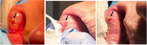 Técnica de mínima incisión: localización de la glándula salival labial.