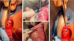 Técnica de mínima incisión: extracción de la glándula salival labial.