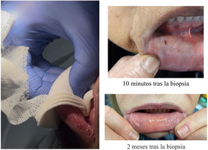 Técnica de mínima incisión: hemostasia y resultado final.